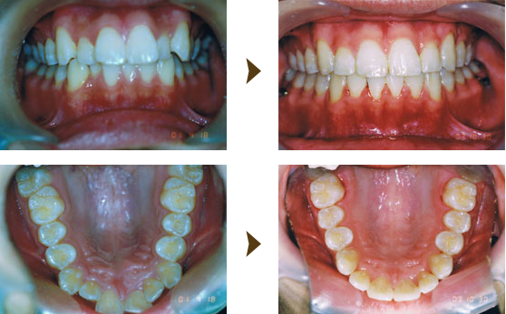 歯列育形成症例：2