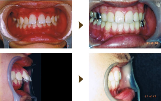 歯列育形成症例：4